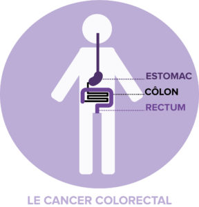 le cancer colorectal localisation